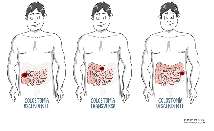 2. Localización colostomía