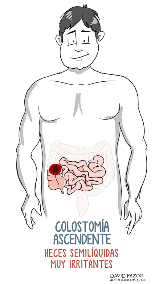 3. Colostomía ascendente