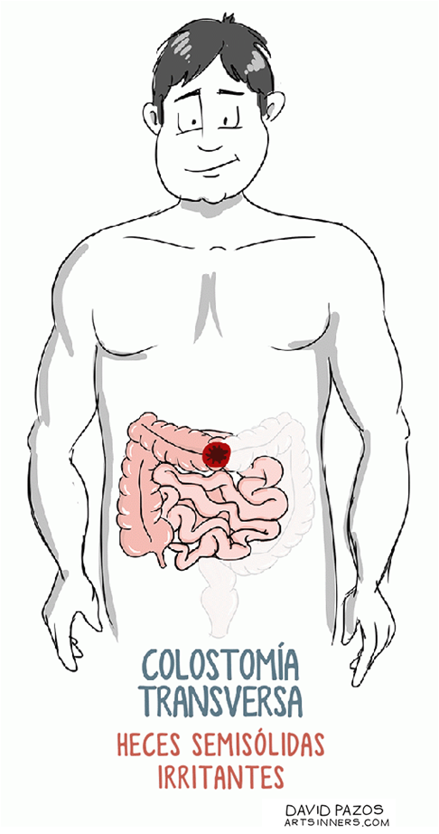 4. Colostomía transversa