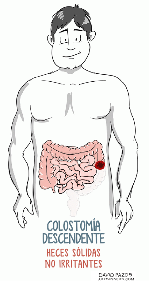 5. Colostomía descendente