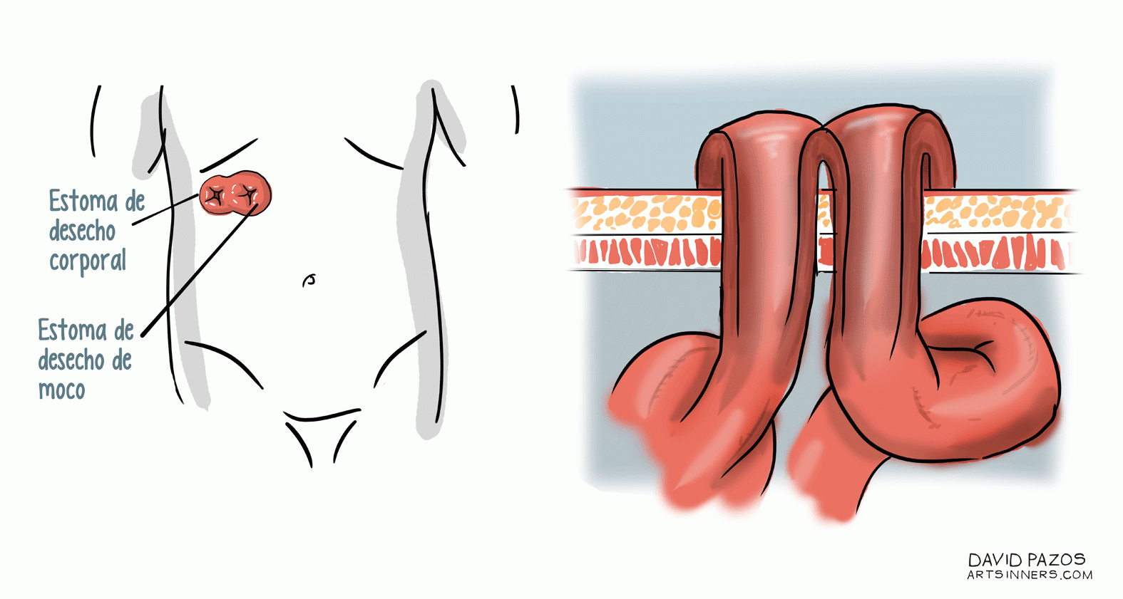 6. Colostomía en asa