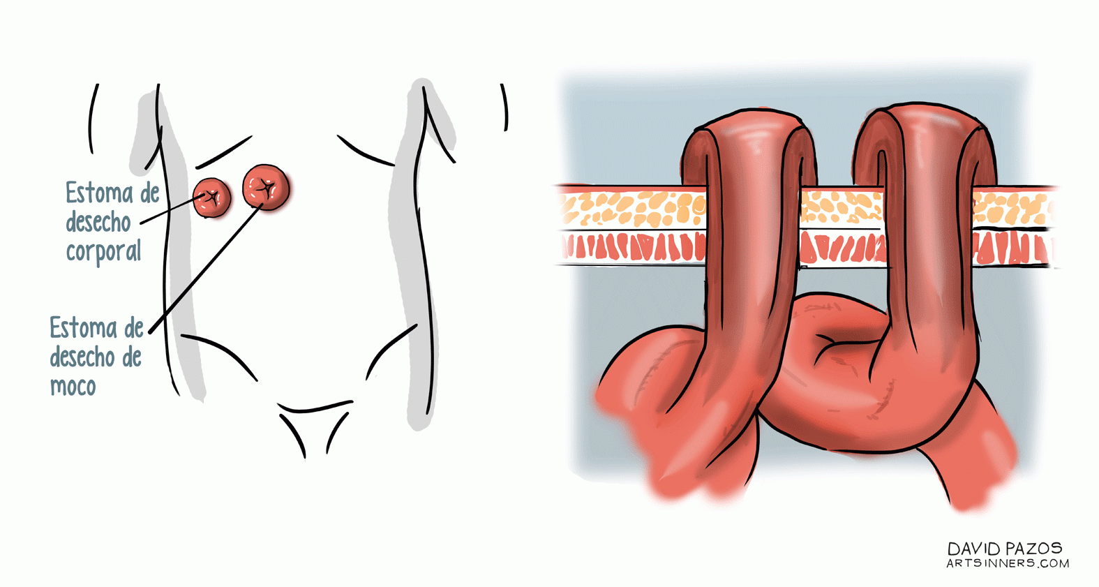 7. Colostomía en cañón de escopeta