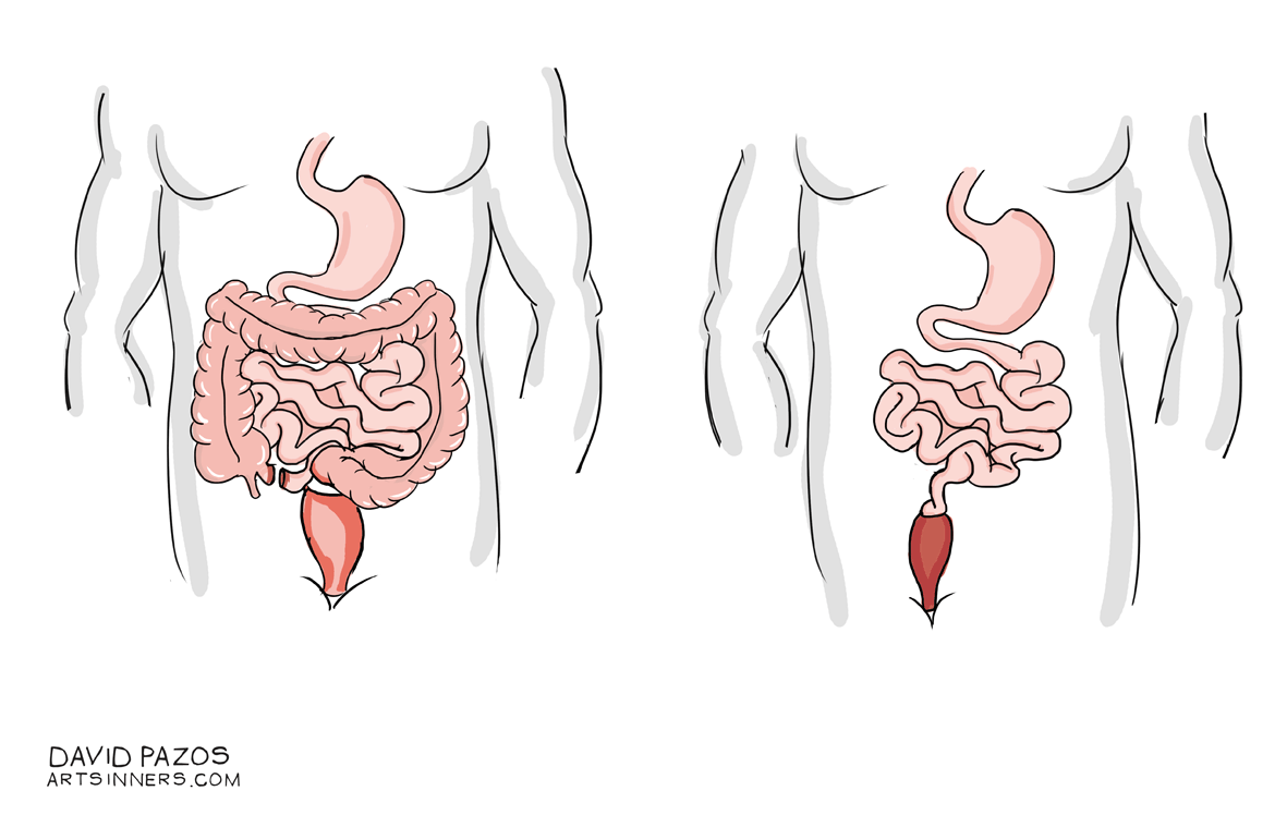 Colectomía total con anastomosis íleorectal