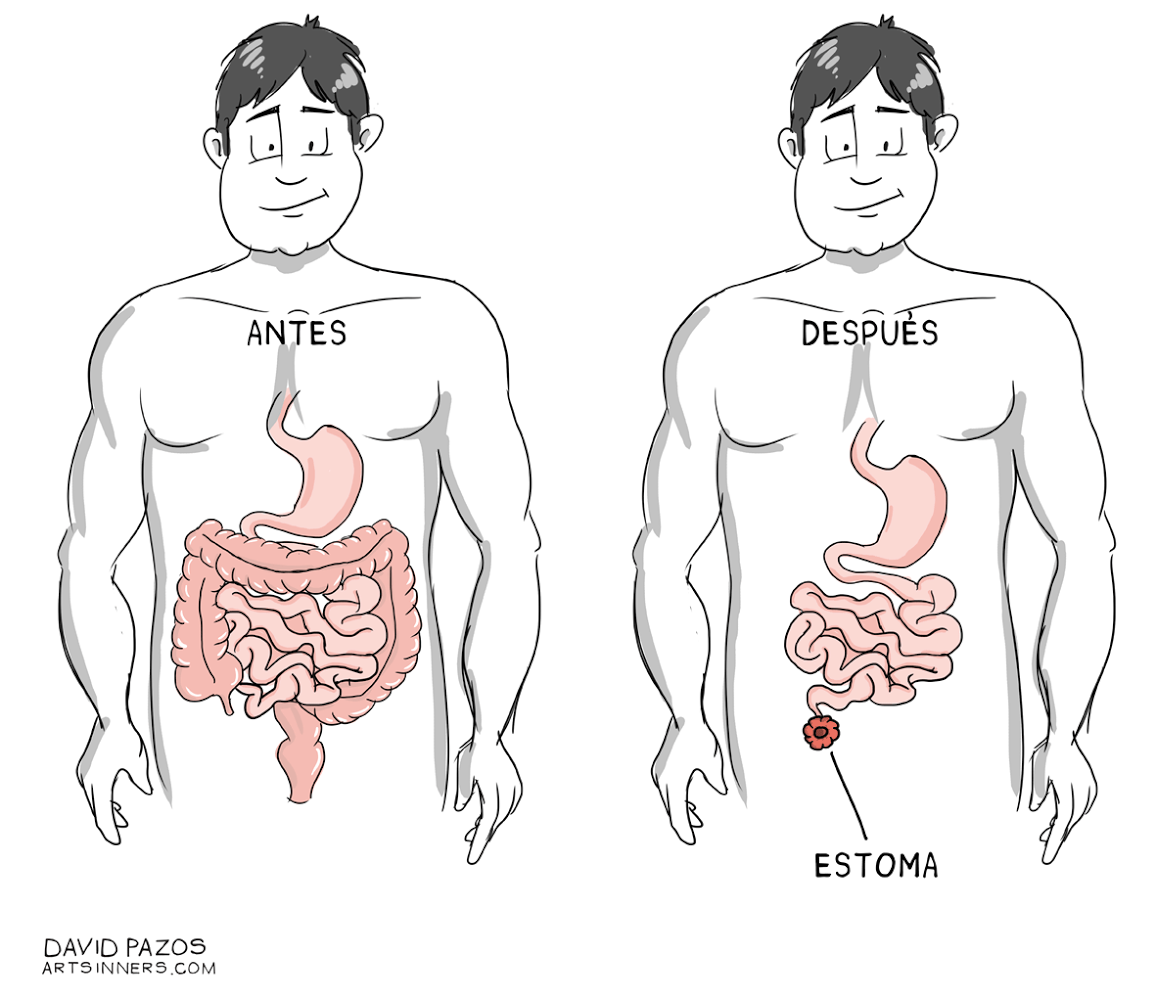 Coloproctectomía total con ileostomía