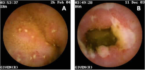 endoscopia