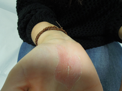 Psoriasis en palma de las manos