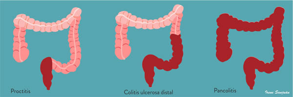 colitisulcera