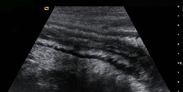 educainflamatoria enfermedad inflamatoria intestinal crohn y ultrasonidos pelvicos